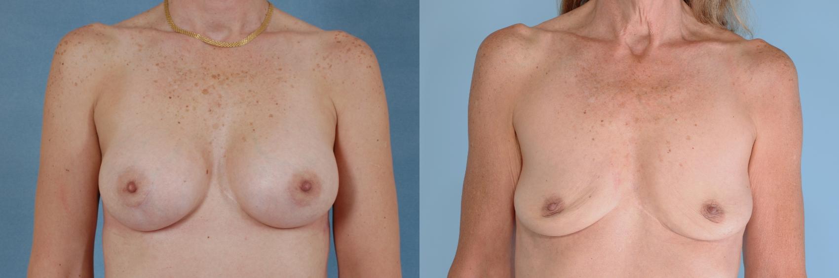 Before & After Breast Revision Surgery Case 748 Front View in Tallahassee, FL