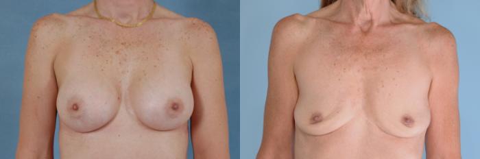 Before & After Breast Revision Surgery Case 748 Front View in Tallahassee, FL