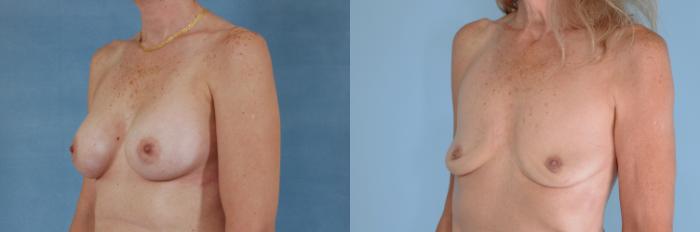 Before & After Breast Revision Surgery Case 748 Left Oblique View in Tallahassee, FL