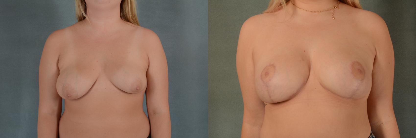 Before & After Breast Surgery to Correct Asymmetry Case 394 View #1 View in Tallahassee, FL