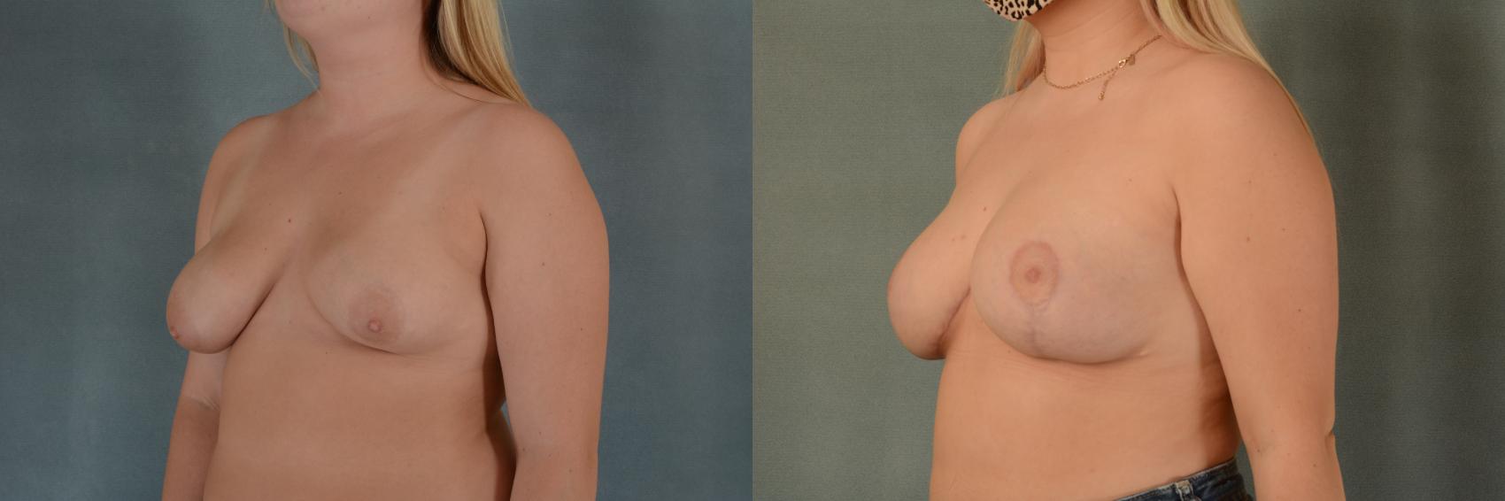 Before & After Breast Surgery to Correct Asymmetry Case 394 View #2 View in Tallahassee, FL