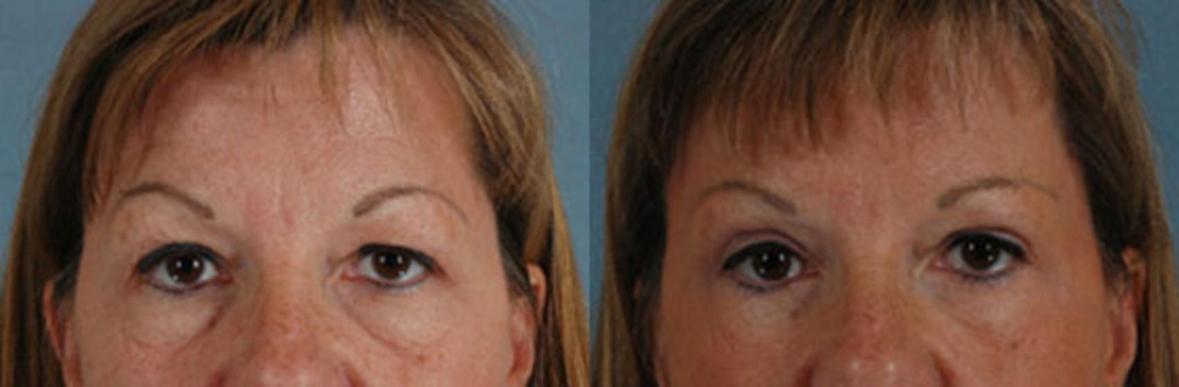 Before & After Brow Lift Case 10 View #1 View in Tallahassee, FL