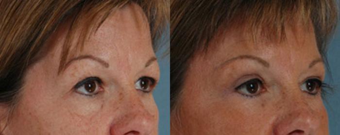 Before & After Brow Lift Case 10 View #2 View in Tallahassee, FL