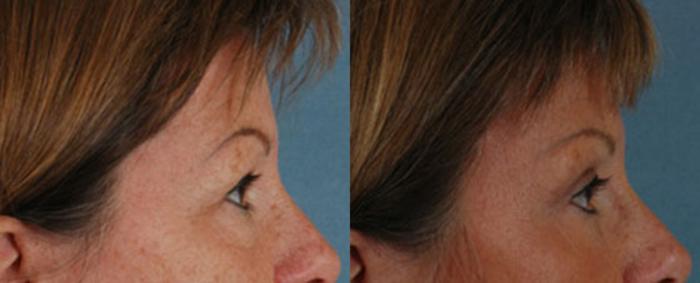 Before & After Brow Lift Case 10 View #3 View in Tallahassee, FL