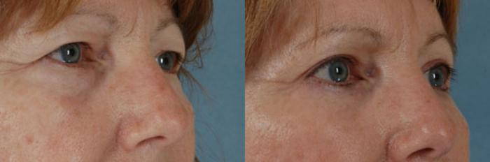 Before & After Brow Lift Case 7 View #2 View in Tallahassee, FL
