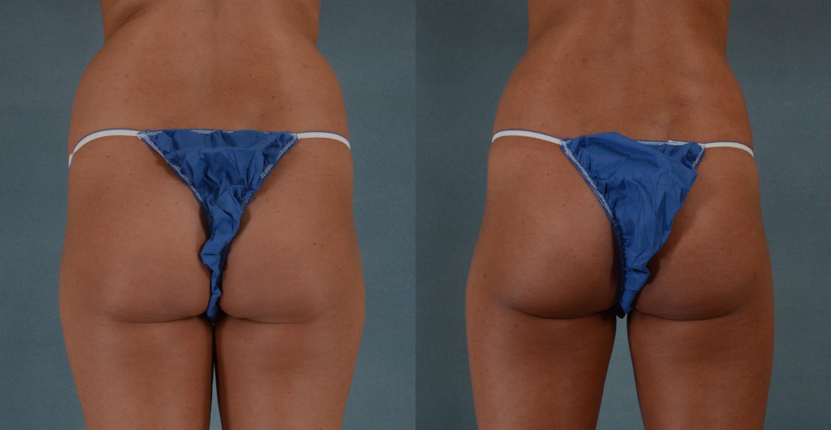 Before & After Buttock Augmentation with Fat Grafting Case 93 View #1 View in Tallahassee, FL
