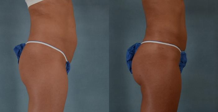 Before & After Buttock Augmentation with Fat Grafting Case 93 View #2 View in Tallahassee, FL