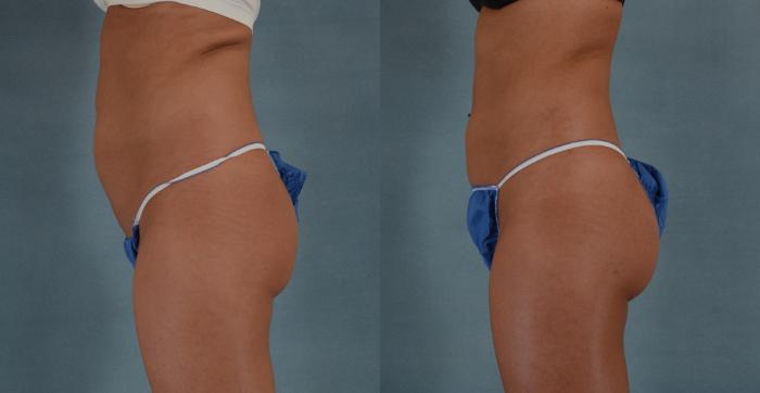 Before & After Buttock Augmentation with Fat Grafting Case 93 View #3 View in Tallahassee, FL