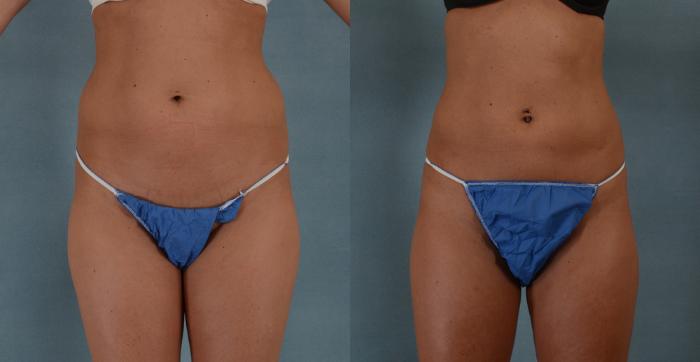Before & After Buttock Augmentation with Fat Grafting Case 93 View #4 View in Tallahassee, FL