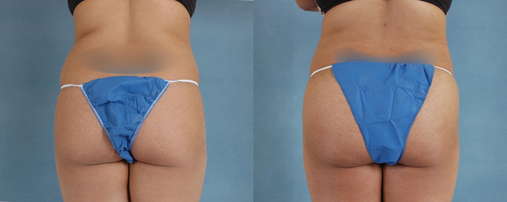 Before & After Buttock Augmentation with Fat Grafting Case 94 View #1 View in Tallahassee, FL