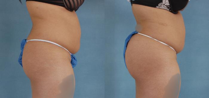 Before & After Buttock Augmentation with Fat Grafting Case 94 View #2 View in Tallahassee, FL