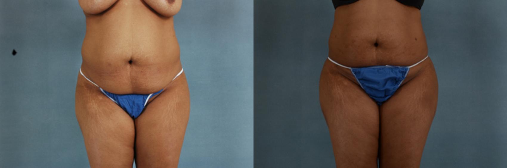 Before & After Buttock Augmentation with Fat Grafting Case 95 View #1 View in Tallahassee, FL