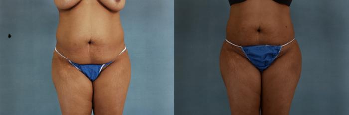 Before & After Buttock Augmentation with Fat Grafting Case 95 View #1 View in Tallahassee, FL