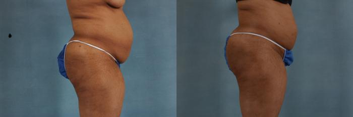 Before & After Buttock Augmentation with Fat Grafting Case 95 View #2 View in Tallahassee, FL