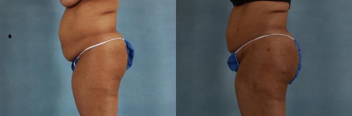 Before & After Buttock Augmentation with Fat Grafting Case 95 View #3 View in Tallahassee, FL