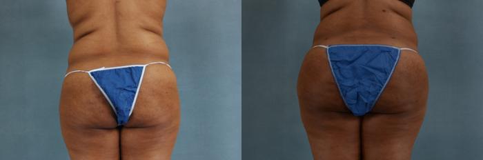 Before & After Buttock Augmentation with Fat Grafting Case 95 View #4 View in Tallahassee, FL