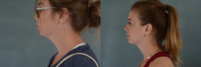Before & After Chin Implant Case 261 View #2 View in Tallahassee, FL