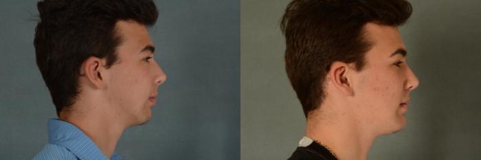 Before & After Chin Implant Case 389 View #2 View in Tallahassee, FL