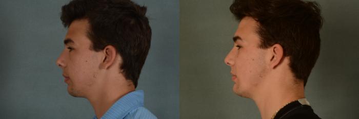 Before & After Chin Implant Case 389 View #3 View in Tallahassee, FL