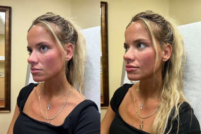 Before & After Dermal Fillers/ Bio-Stimulators Case 553 Left Oblique View in Tallahassee, FL