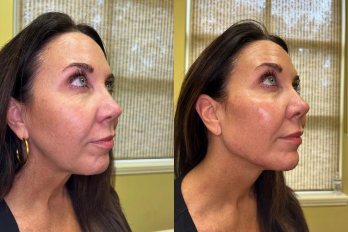 Before & After Dermal Fillers/ Bio-Stimulators Case 554 Right Oblique View in Tallahassee, FL