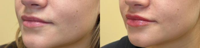 Before & After Dermal Fillers/ Bio-Stimulators Case 555 Left Oblique View in Tallahassee, FL