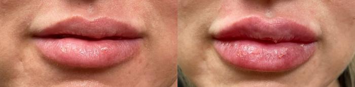 Before & After Dermal Fillers/ Bio-Stimulators Case 559 Front View in Tallahassee, FL