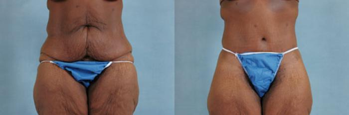 Before & After Extended Tummy Tuck (Abdominoplasty)  Case 100 View #1 View in Tallahassee, FL