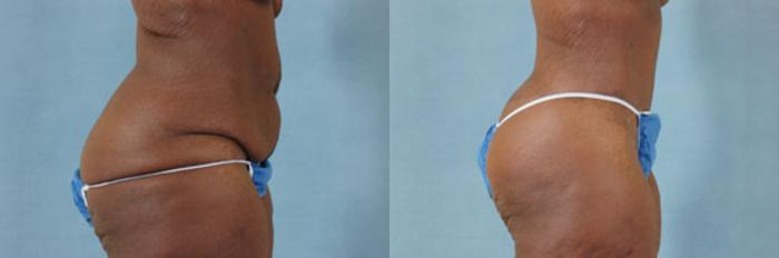 Before & After Extended Tummy Tuck (Abdominoplasty)  Case 100 View #2 View in Tallahassee, FL