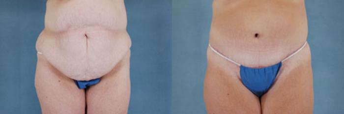 Before & After Extended Tummy Tuck (Abdominoplasty)  Case 101 View #1 View in Tallahassee, FL