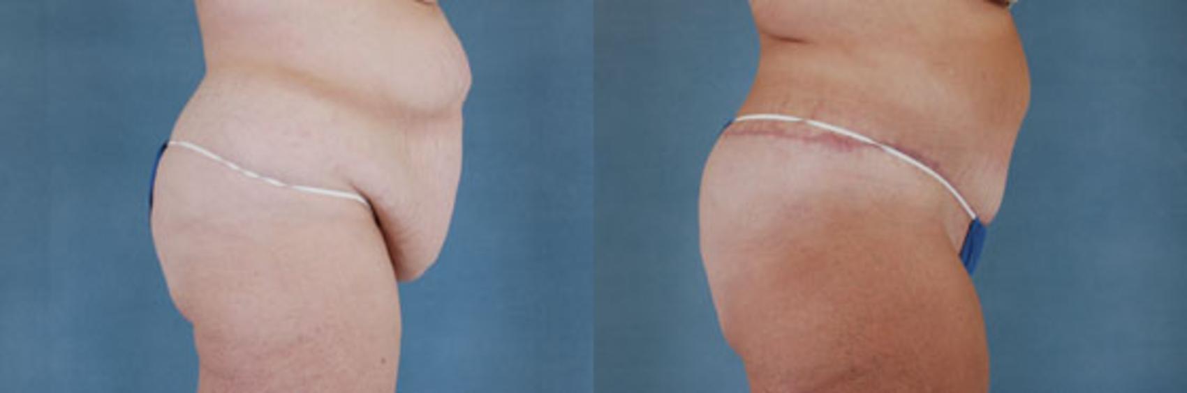 Before & After Extended Tummy Tuck (Abdominoplasty)  Case 101 View #2 View in Tallahassee, FL