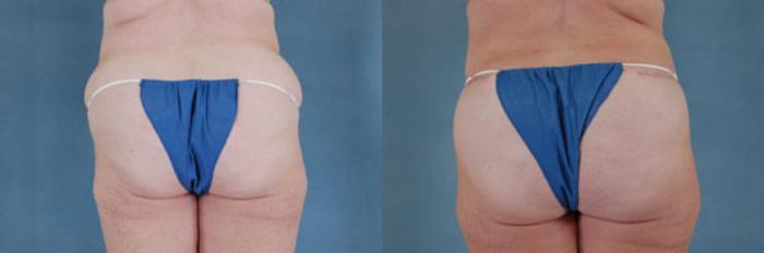 Before & After Extended Tummy Tuck (Abdominoplasty)  Case 101 View #3 View in Tallahassee, FL