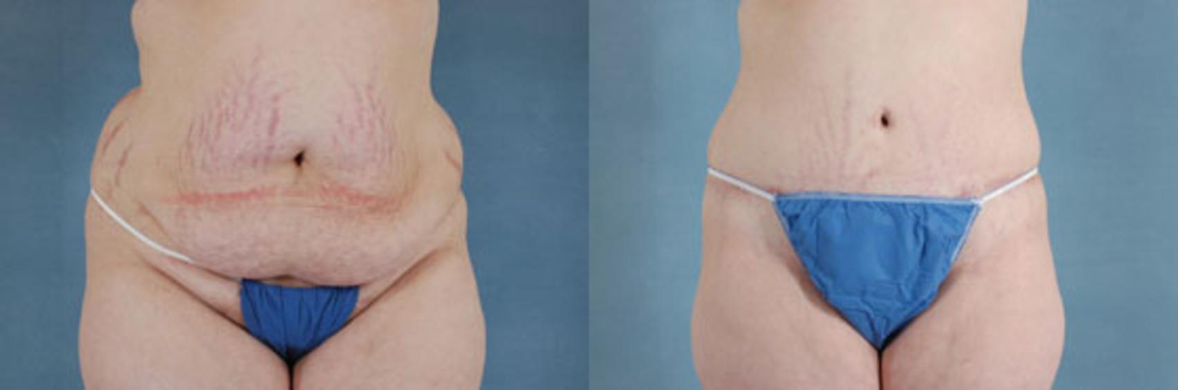 Before & After Extended Tummy Tuck (Abdominoplasty)  Case 102 View #1 View in Tallahassee, FL