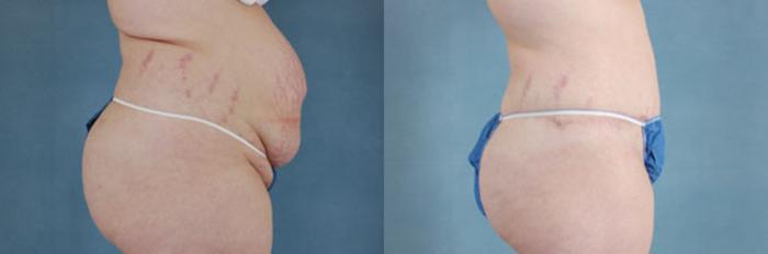 Before & After Extended Tummy Tuck (Abdominoplasty)  Case 102 View #2 View in Tallahassee, FL