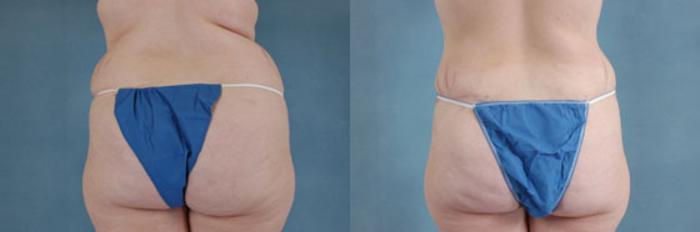 Before & After Extended Tummy Tuck (Abdominoplasty)  Case 102 View #3 View in Tallahassee, FL
