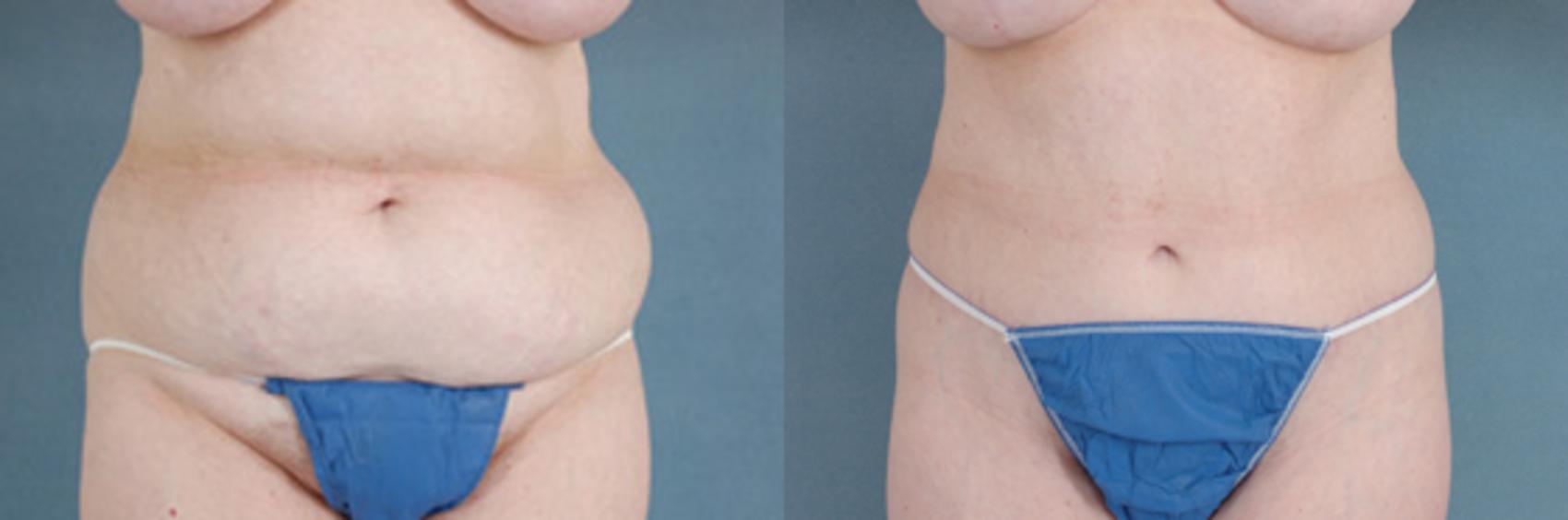 Before & After Extended Tummy Tuck (Abdominoplasty)  Case 103 View #1 View in Tallahassee, FL