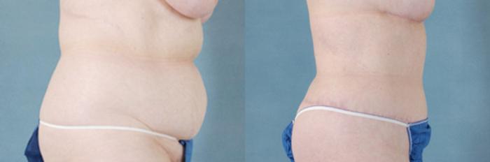 Before & After Extended Tummy Tuck (Abdominoplasty)  Case 103 View #2 View in Tallahassee, FL