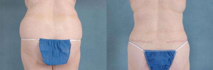 Before & After Extended Tummy Tuck (Abdominoplasty)  Case 103 View #3 View in Tallahassee, FL