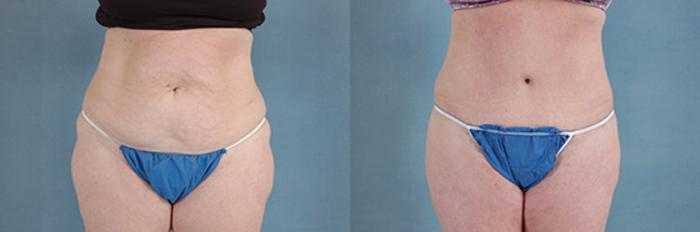 Before & After Extended Tummy Tuck (Abdominoplasty)  Case 104 View #1 View in Tallahassee, FL