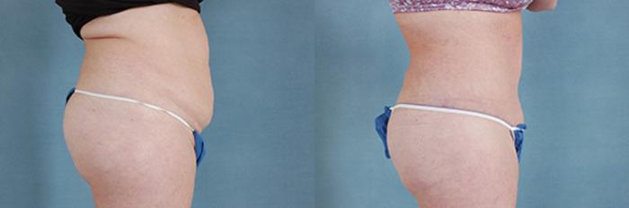 Before & After Extended Tummy Tuck (Abdominoplasty)  Case 104 View #2 View in Tallahassee, FL