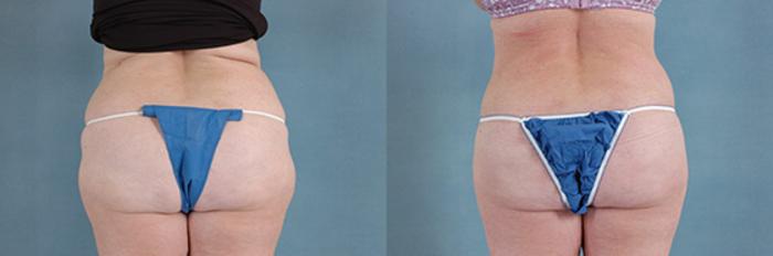 Before & After Extended Tummy Tuck (Abdominoplasty)  Case 104 View #3 View in Tallahassee, FL