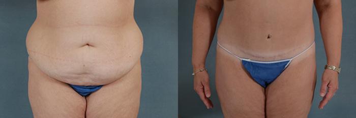 Before & After Extended Tummy Tuck (Abdominoplasty)  Case 105 View #1 View in Tallahassee, FL