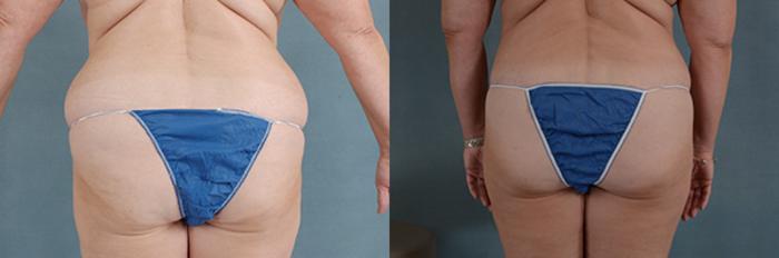 Before & After Extended Tummy Tuck (Abdominoplasty)  Case 105 View #2 View in Tallahassee, FL