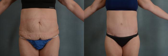 Tummy Tuck Before and After Photos Case 9, Melbourne, FL