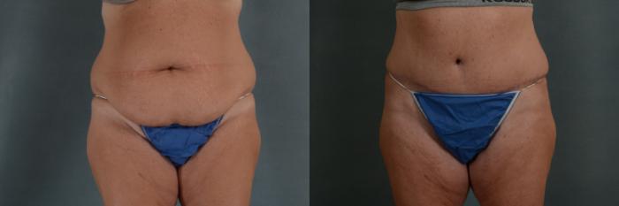 Before & After Extended Tummy Tuck (Abdominoplasty)  Case 288 View #1 View in Tallahassee, FL
