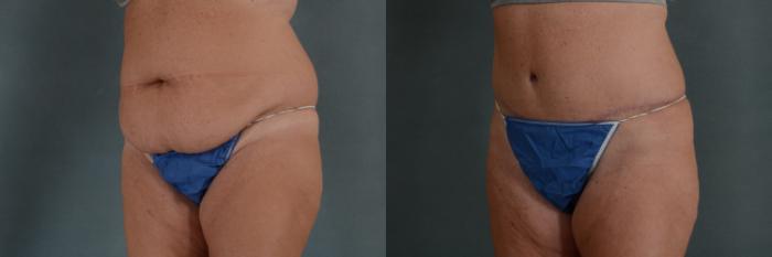 Before & After Extended Tummy Tuck (Abdominoplasty)  Case 288 View #2 View in Tallahassee, FL