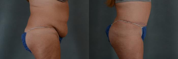Before & After Extended Tummy Tuck (Abdominoplasty)  Case 288 View #3 View in Tallahassee, FL