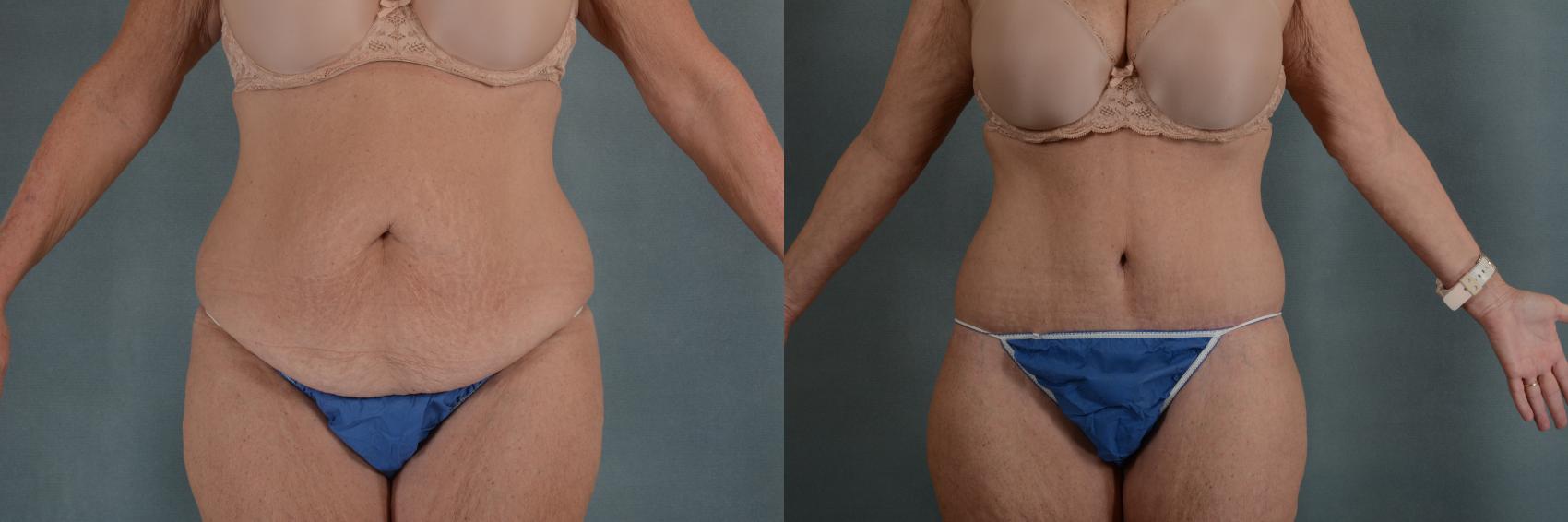 Before & After Extended Tummy Tuck (Abdominoplasty)  Case 305 View #1 View in Tallahassee, FL