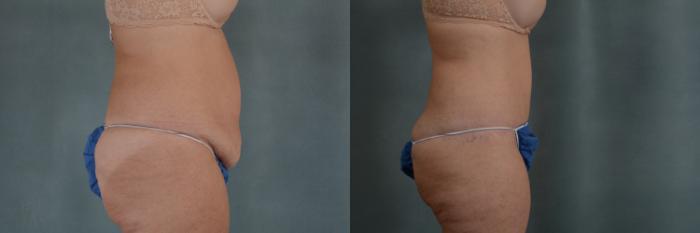 Before & After Extended Tummy Tuck (Abdominoplasty)  Case 305 View #2 View in Tallahassee, FL