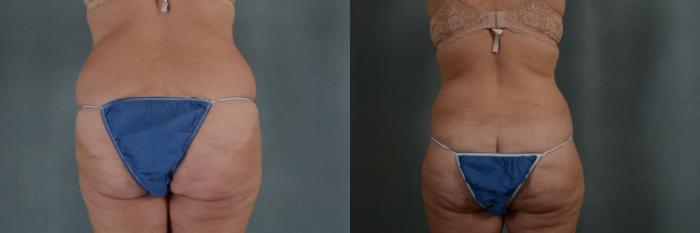 Before & After Extended Tummy Tuck (Abdominoplasty)  Case 305 View #3 View in Tallahassee, FL